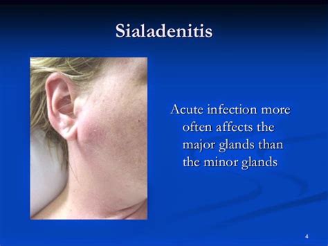 prada gland infection|Salivary Gland Infection (Sialadenitis) .